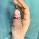 陇南农妇断指6小时在陕西冶金医院断指再植