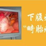 下腹痛竟是&ldquo;畸胎瘤扭转&rdquo;！妇产科医生一招快速复位