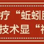 陕西冶金医院：治疗&ldquo;蚯蚓腿&rdquo;，微创技术显&ldquo;神通&rdquo;