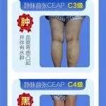 静脉曲张，您属于哪一期？