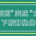 下肢静脉曲张如何吞噬掉你的血管健康?