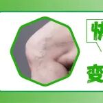 快低头看看腿！别让 &ldquo;小青筋&rdquo; 变成 &ldquo;大麻烦&rdquo;