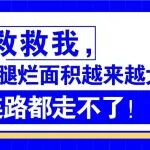&ldquo;救救我，双腿折磨的我连路都走不了！&rdquo;72岁下肢静脉曲张患者的挣扎