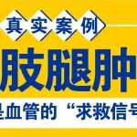 静脉曲张真实案例：腿肿！原来是血管的&ldquo;求救信号&rdquo;