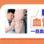 腿爬满&ldquo;蚯蚓&rdquo;？血管外科医生：一旦血栓脱落，随时会危及生命！
