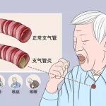 冷空气来袭丨对付老慢支，有这篇文章就够了