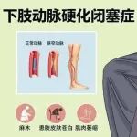 腿凉 发麻 走路疼！血管外科医生提醒：秋冬警惕腿梗