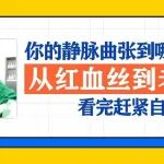 你的静脉曲张到哪一级了？从红血丝到老烂腿，看完赶紧自查丨附真实案例